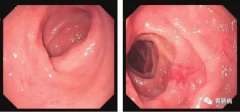萎縮性胃炎不可怕，只要