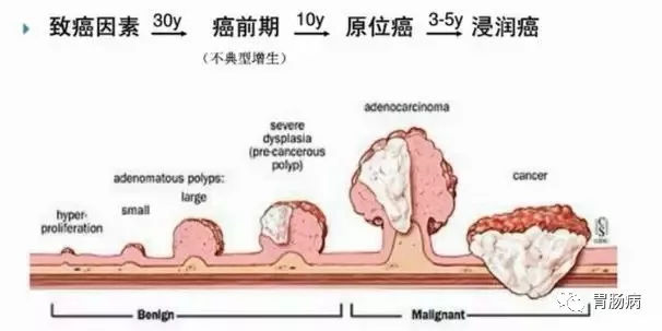 體檢查出腸息肉一定要切除！ 95%腸癌由它演變而來(lái)